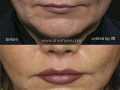 central-lip-lift-02-08-14-1-Rered