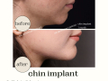 Beige Elegant Minimalist Beauty Skincare Before After Instagram Post - 31