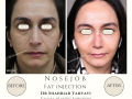 Real examples of facial fat transfer by Dr. Shahriar Yahyavi, an aesthetic surgeon in Tehran. See the natural and long-lasting results of this rejuvenation procedure.