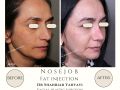 Real examples of facial fat transfer by Dr. Shahriar Yahyavi, an aesthetic surgeon in Tehran. See the natural and long-lasting results of this rejuvenation procedure.  