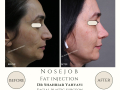 Real examples of facial fat transfer by Dr. Shahriar Yahyavi, an aesthetic surgeon in Tehran. See the natural and long-lasting results of this rejuvenation procedure.  