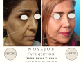 Real examples of facial fat transfer by Dr. Shahriar Yahyavi, an aesthetic surgeon in Tehran. See the natural and long-lasting results of this rejuvenation procedure.  