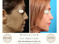 Real examples of facial fat transfer by Dr. Shahriar Yahyavi, an aesthetic surgeon in Tehran. See the natural and long-lasting results of this rejuvenation procedure.  