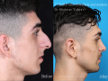 Aminiomid-otoplasty-1