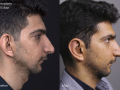 Khorasani-Hosein03-02-19-otoplasty-23