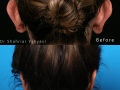 KianMina-otoplasty3