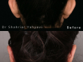 SalmaniSajedeh2-otoplasty