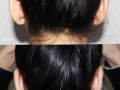 manonayeh-rhino-OTOPLASTY