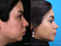 BUCCAL-RINO2