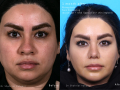 BUCCAL-RINO3-liposuction