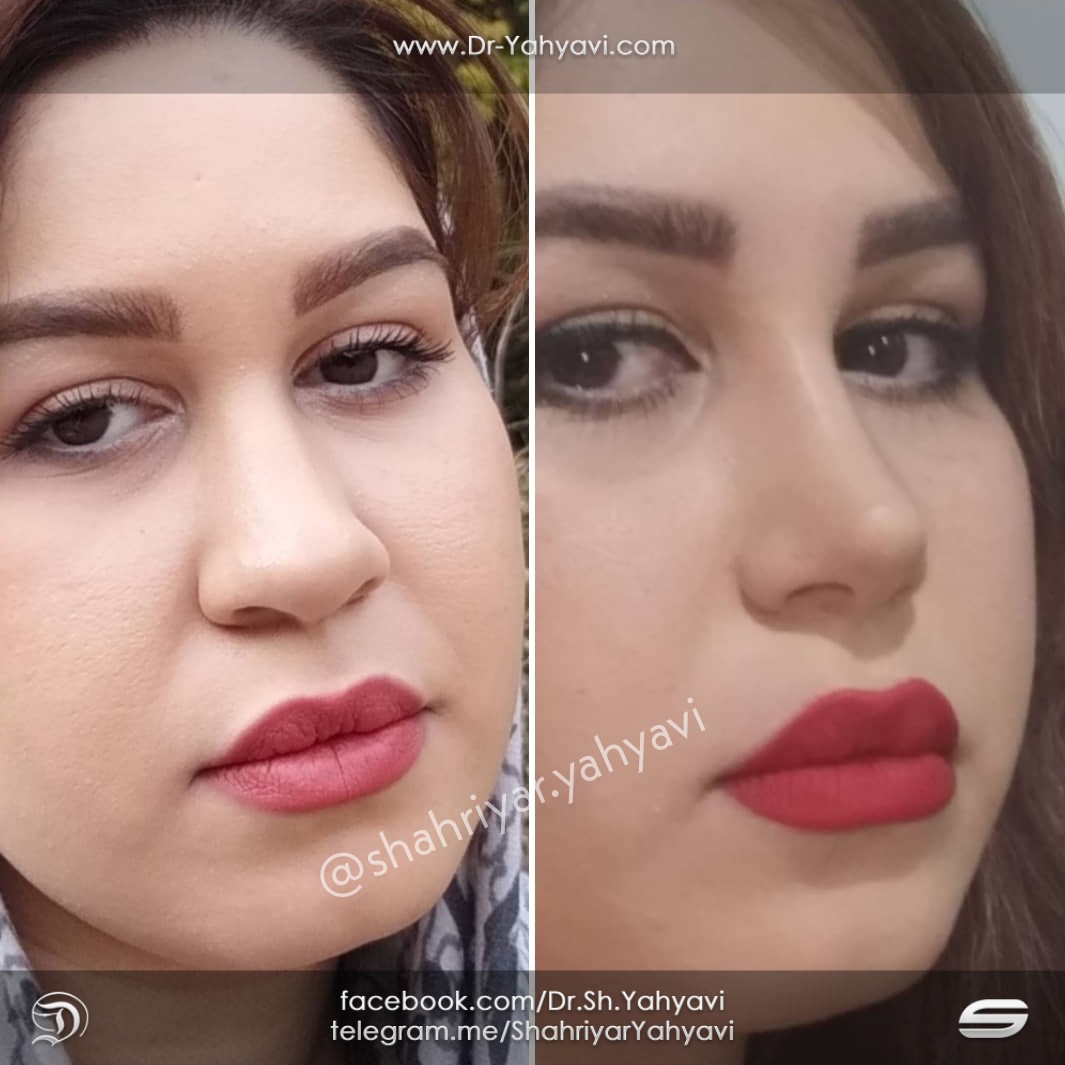 Marzieh (Rhinoplasty in Iran)