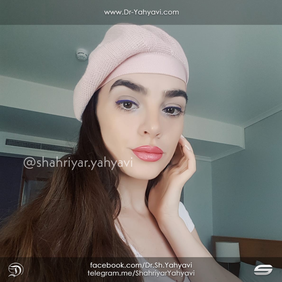 Aniela (Rhinoplasty in Iran)