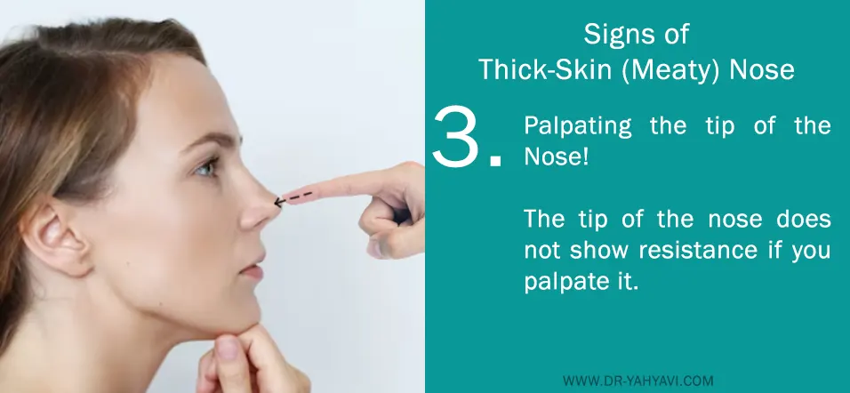 Palpating Thick-Skin Nose