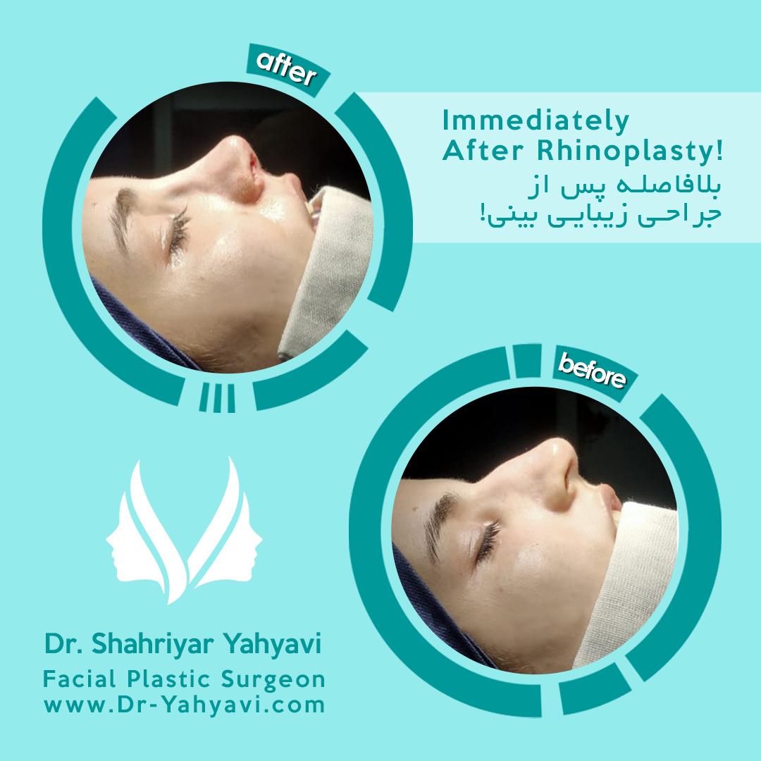 درمان خشکی دهان پس از عمل بینی دکتر شهریار یحیوی جراح زیبایی بینی