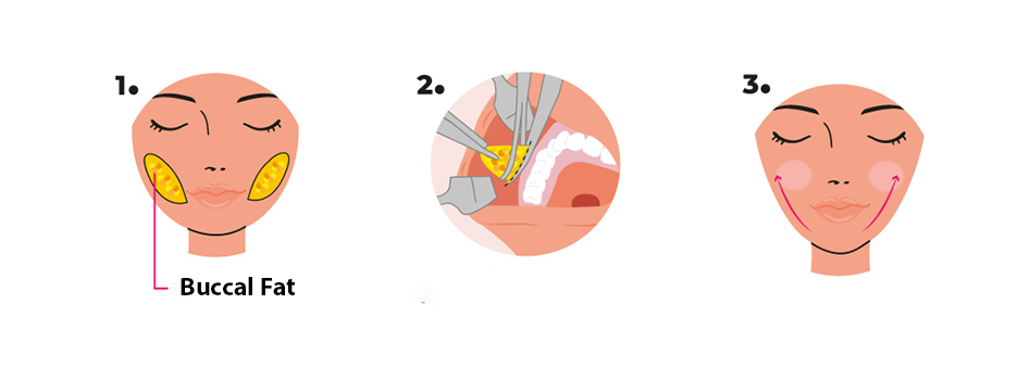 در جراحی بوکال، چربی‌های اضافی که در ناحیه گونه‌ها قرار دارند، از طریق یک برش کوچک در داخل دهان برداشته می‌شوند. این عمل به صورت سرپایی و بدون نیاز به بستری شدن در بیمارستان انجام می‌شود و دوره بهبودی کوتاهی دارد. به دلیل عدم نیاز به برش‌های خارجی، هیچ اسکار یا رد عمل جراحی بر روی صورت باقی نمی‌ماند.